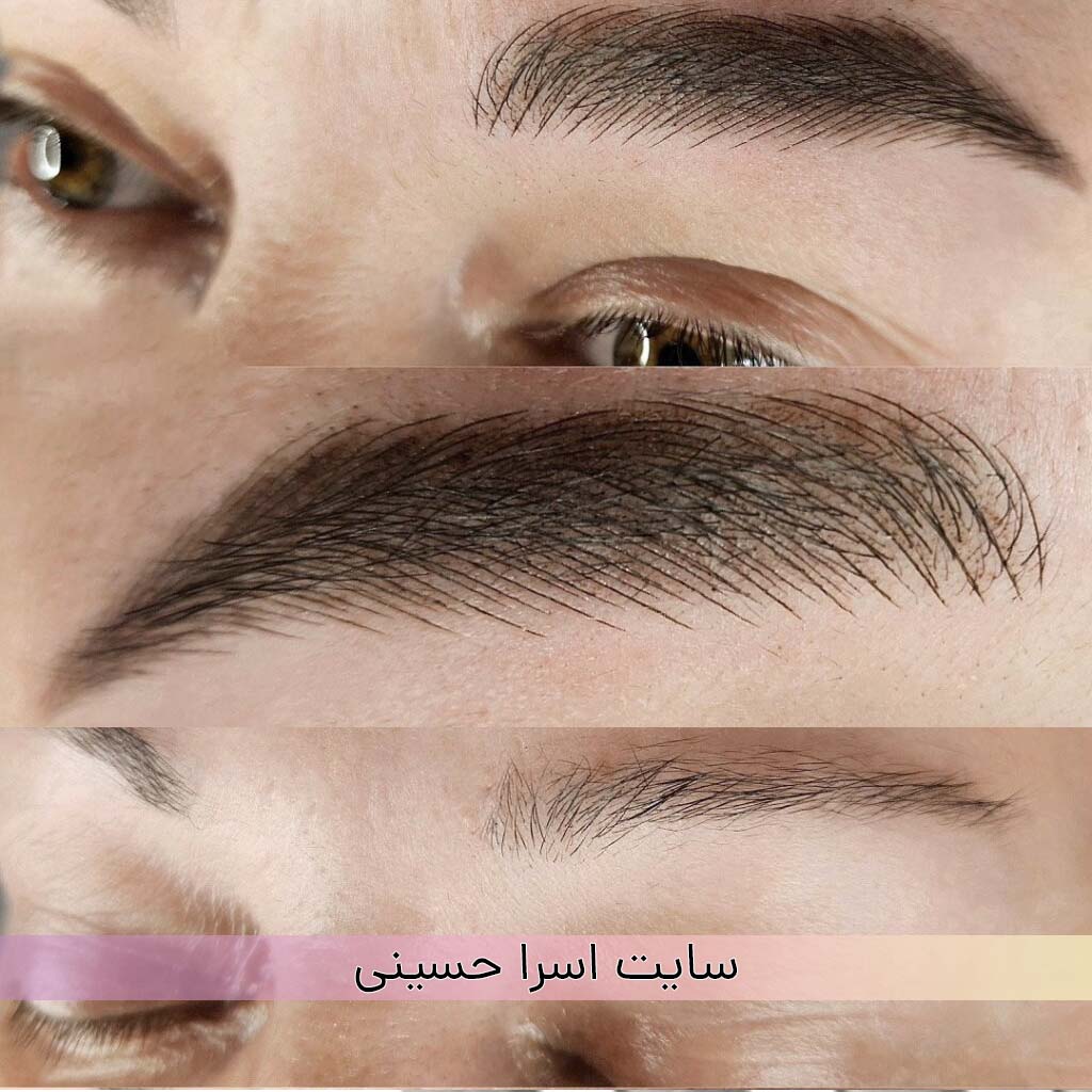 تفاوت میکروبلیدینگ و میکروپیگمنتیشن