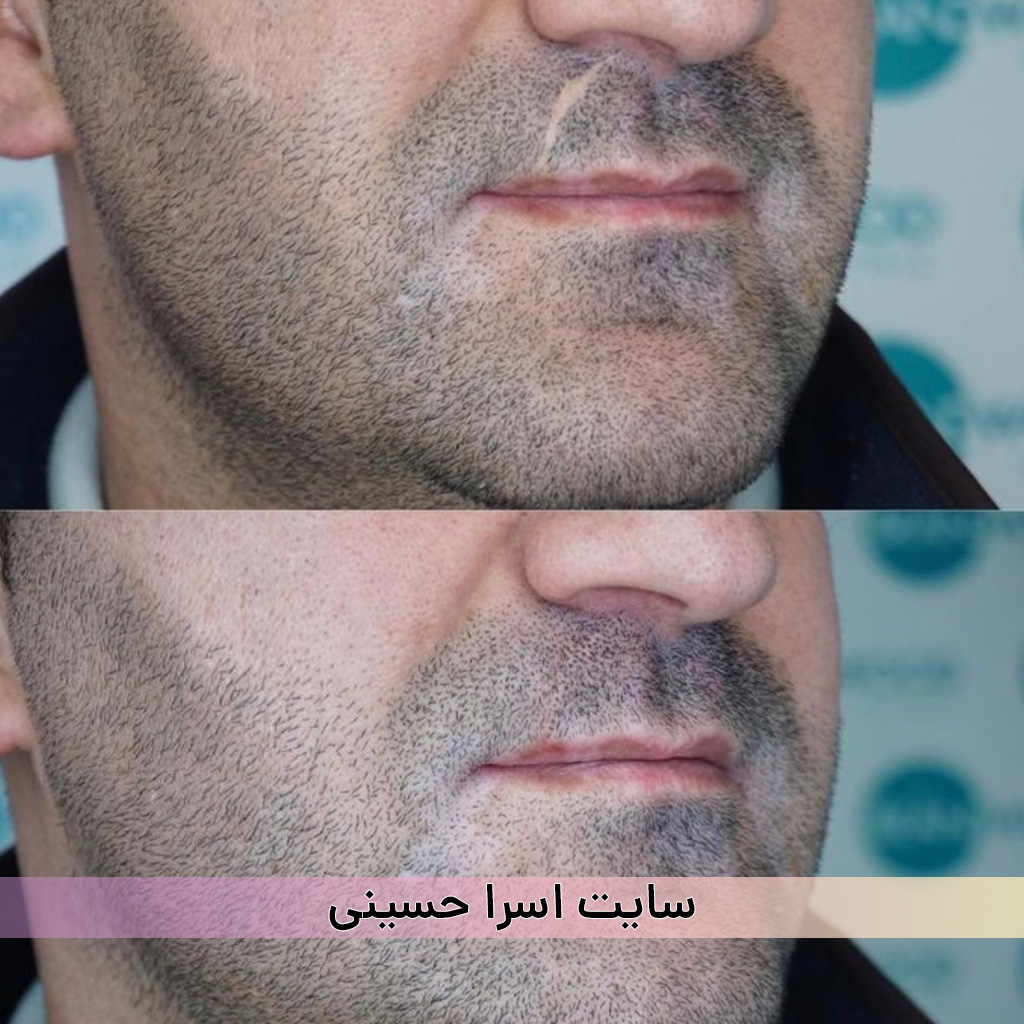 اسکالپ سبیل از بین بردن رد بخیه اسرا حسینی