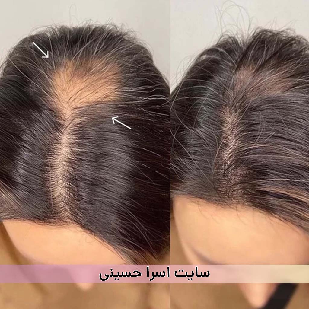 اسکالپ سر خانم ها