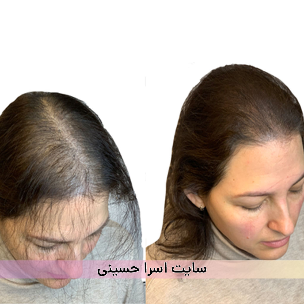 رفع کم پشتی موهای سر