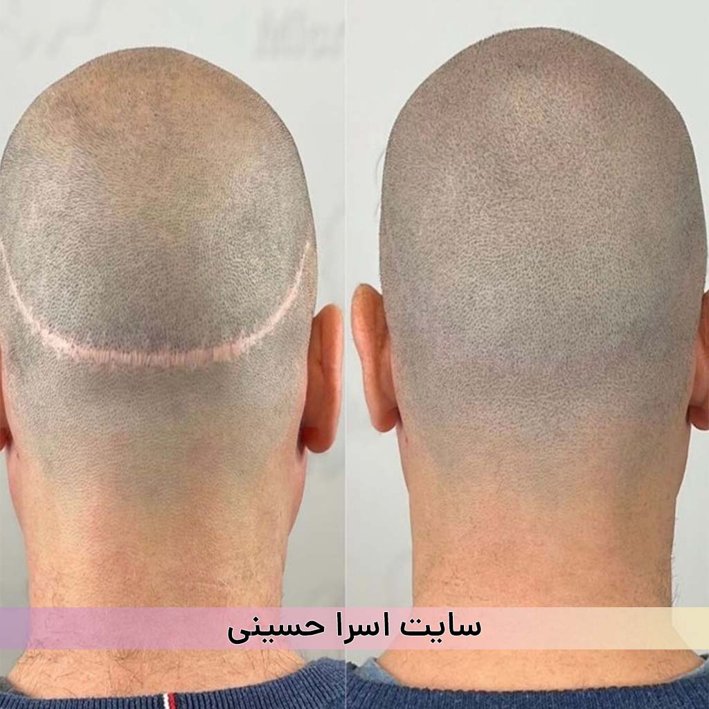 اسکالپ سر از بین بردن رد بخیه اسرا حسینی