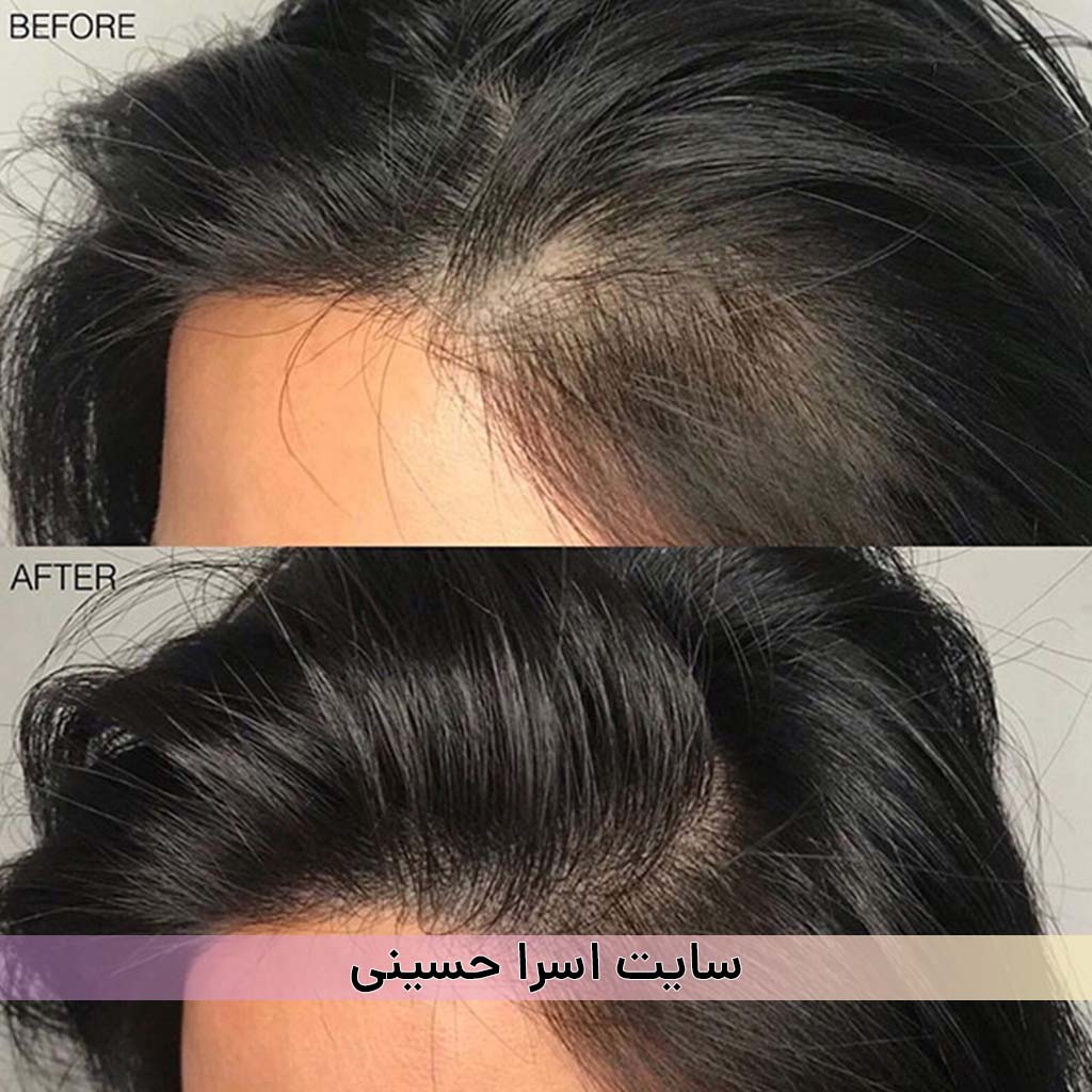 اسکالپ سر خانم ها