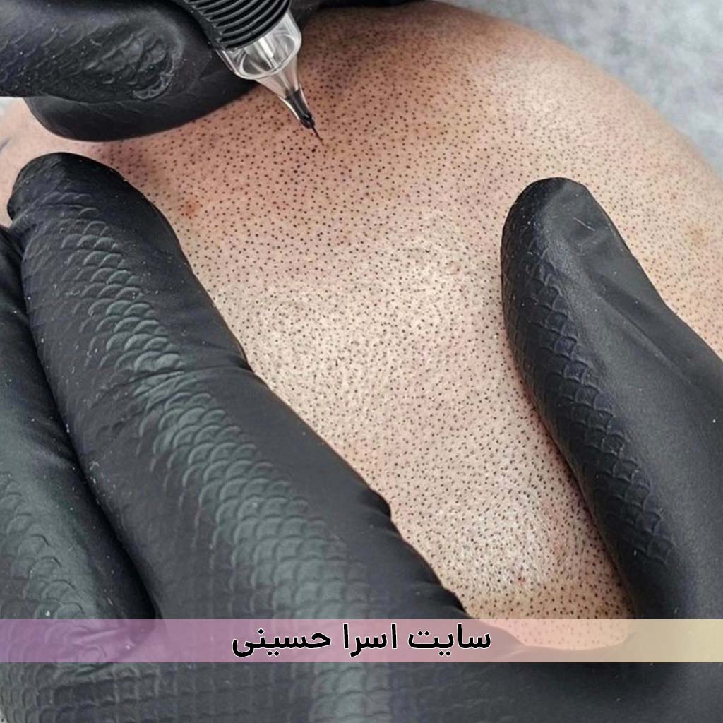 میکرواسکالپ سر
