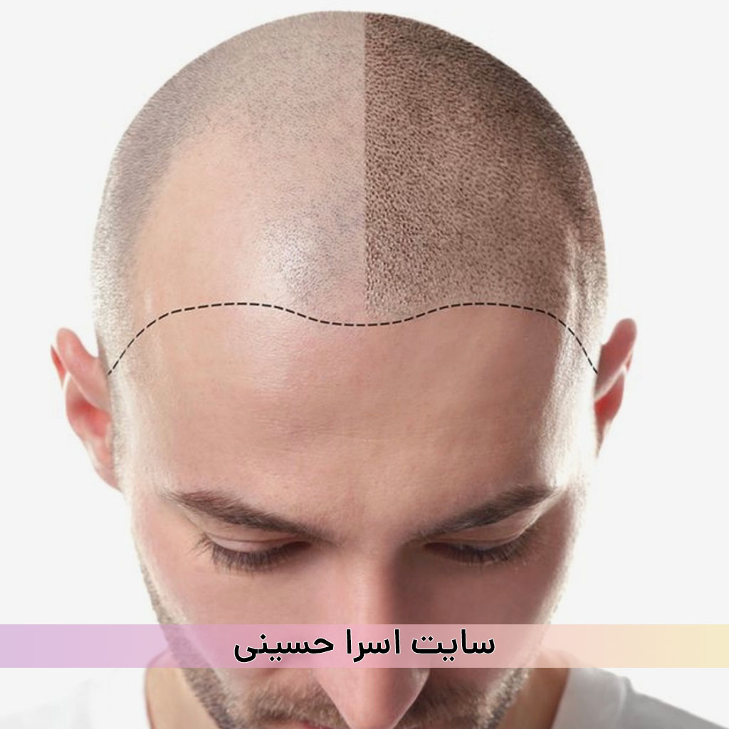 اسکالپ سر