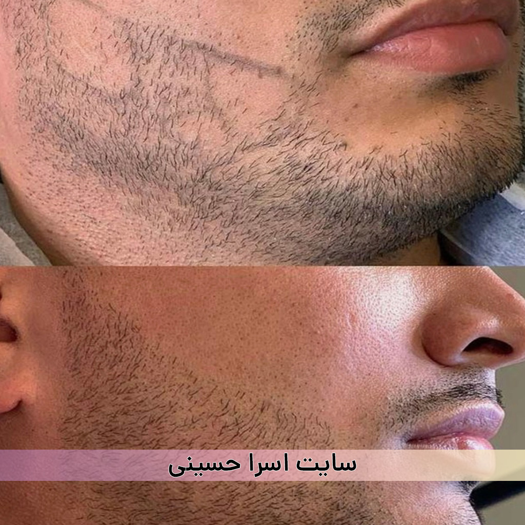 میکرواسکالپ ریش